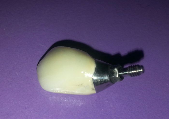 Screw Retained Implant Crown