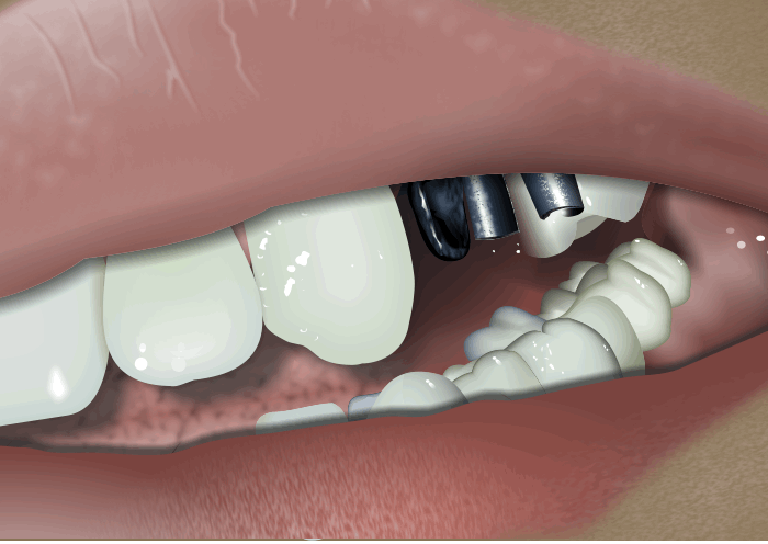 Implants Supported Bridge Animation©