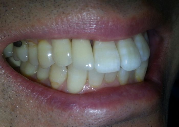 Single Tooth Implant After Photo - Case 1