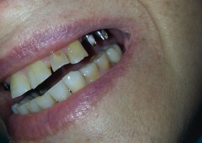 Single Tooth Implant Before Photo - Case 2