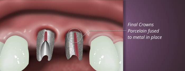 Abutment Made by the Lab