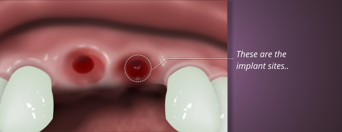 Dental Implants Sites in the Mouth