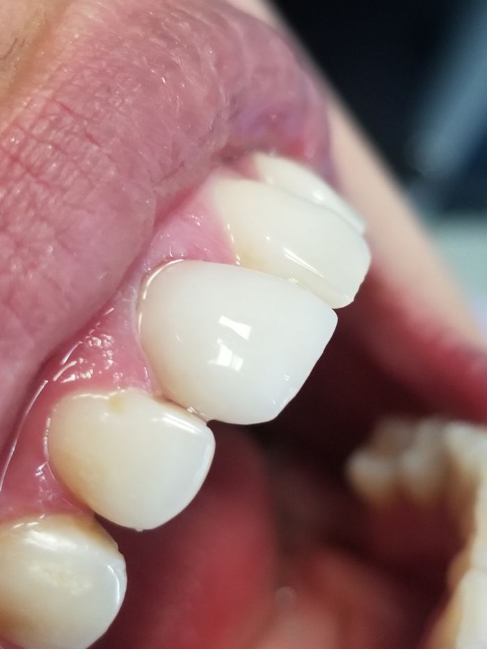 Implant Crowns Case After 