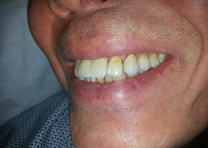 Upper Front Implant Side Photo After