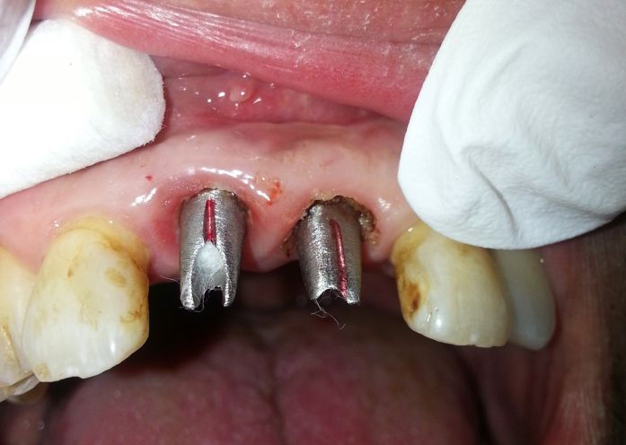 Upper Front Dental Implant photo Before 