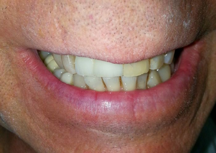 Two Implants Zirconia Crowns in Place